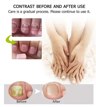 Sistem Eficient De Anti Inflamatorii Femei/Bărbați Anti Infecție Unghiilor Fungice Instant Beauty Gel Crema Picior Deget De La Picior Fi A Sănătății 